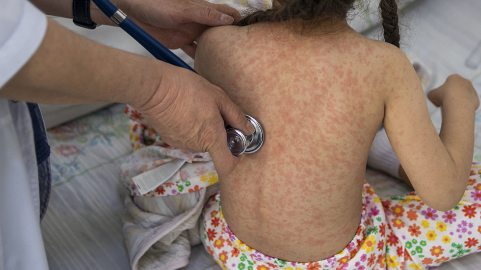 Suman 4 mil 353 casos de sarampión y 17 muertes en el país, reporta Ssa