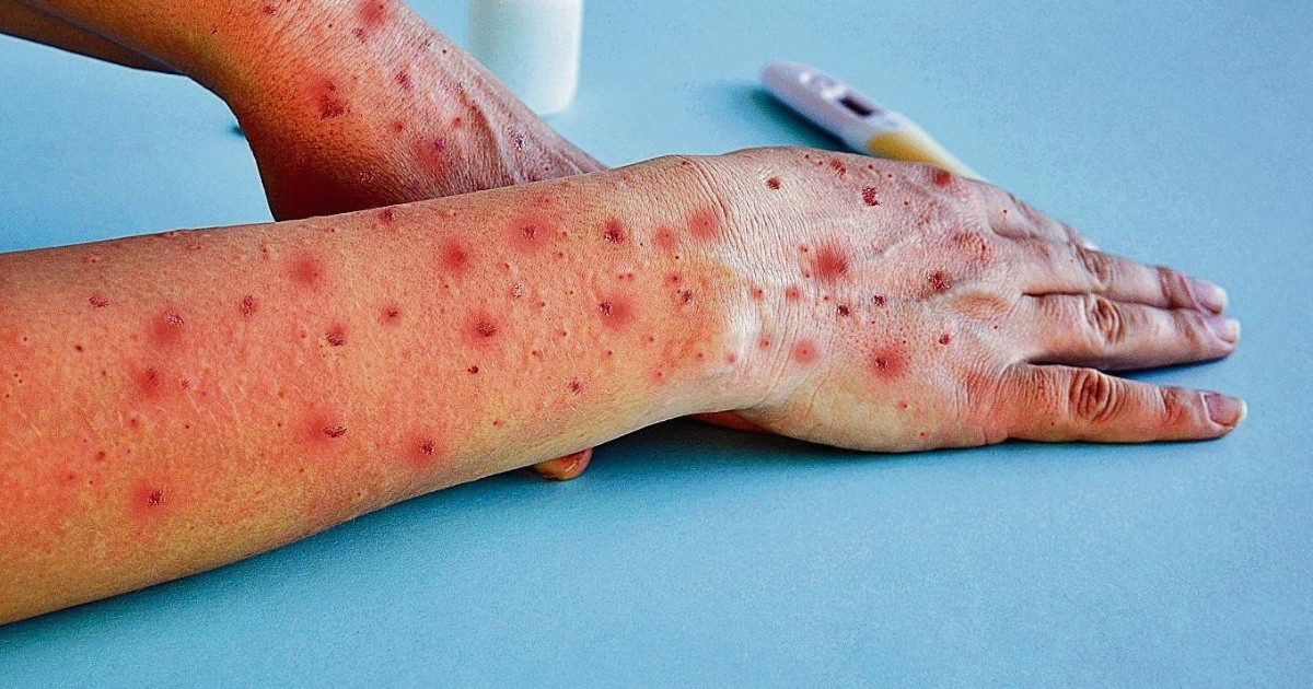 La OMS levanta la emergencia sanitaria internacional por la mpox ante el descenso de casos