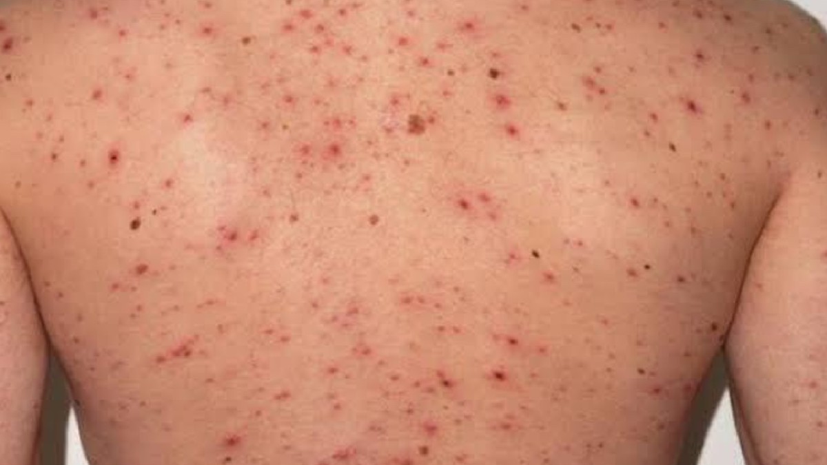 México registra 23 muertes y más de cinco mil casos de sarampión