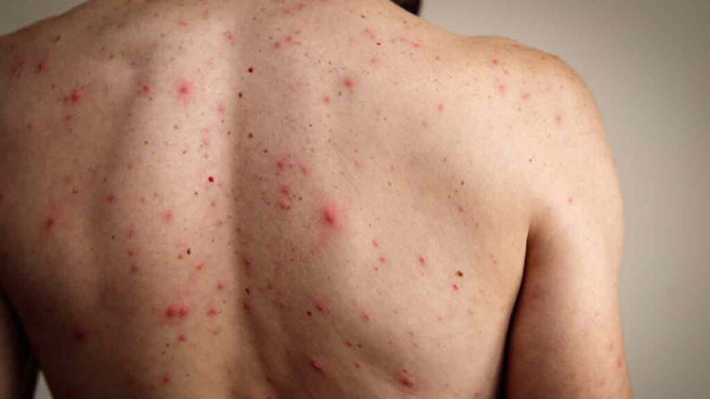 México, en riesgo de perder el estatus de “país libre de sarampión”: OPS