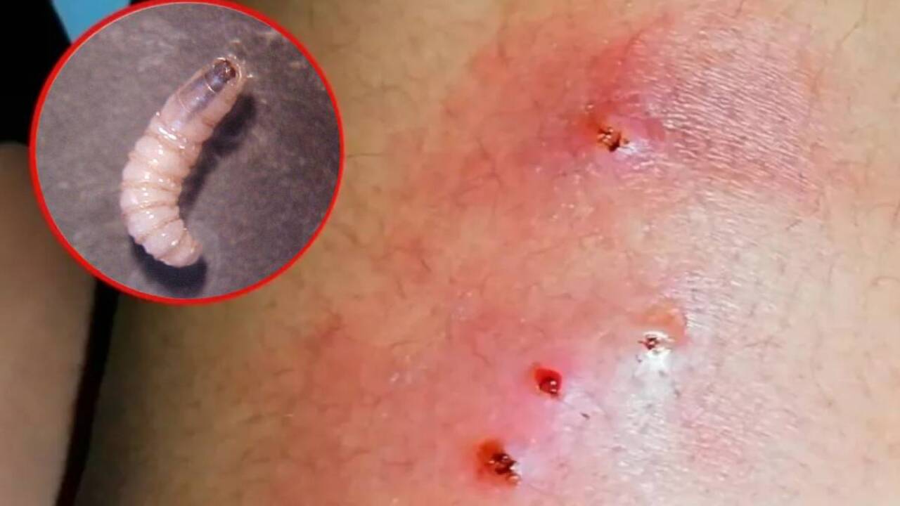 Suman 73 casos en México de miasis en humanos